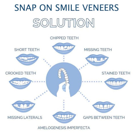 on Veneers Clip on Veneers Teeth Cover Temporary Smile White - Image 6