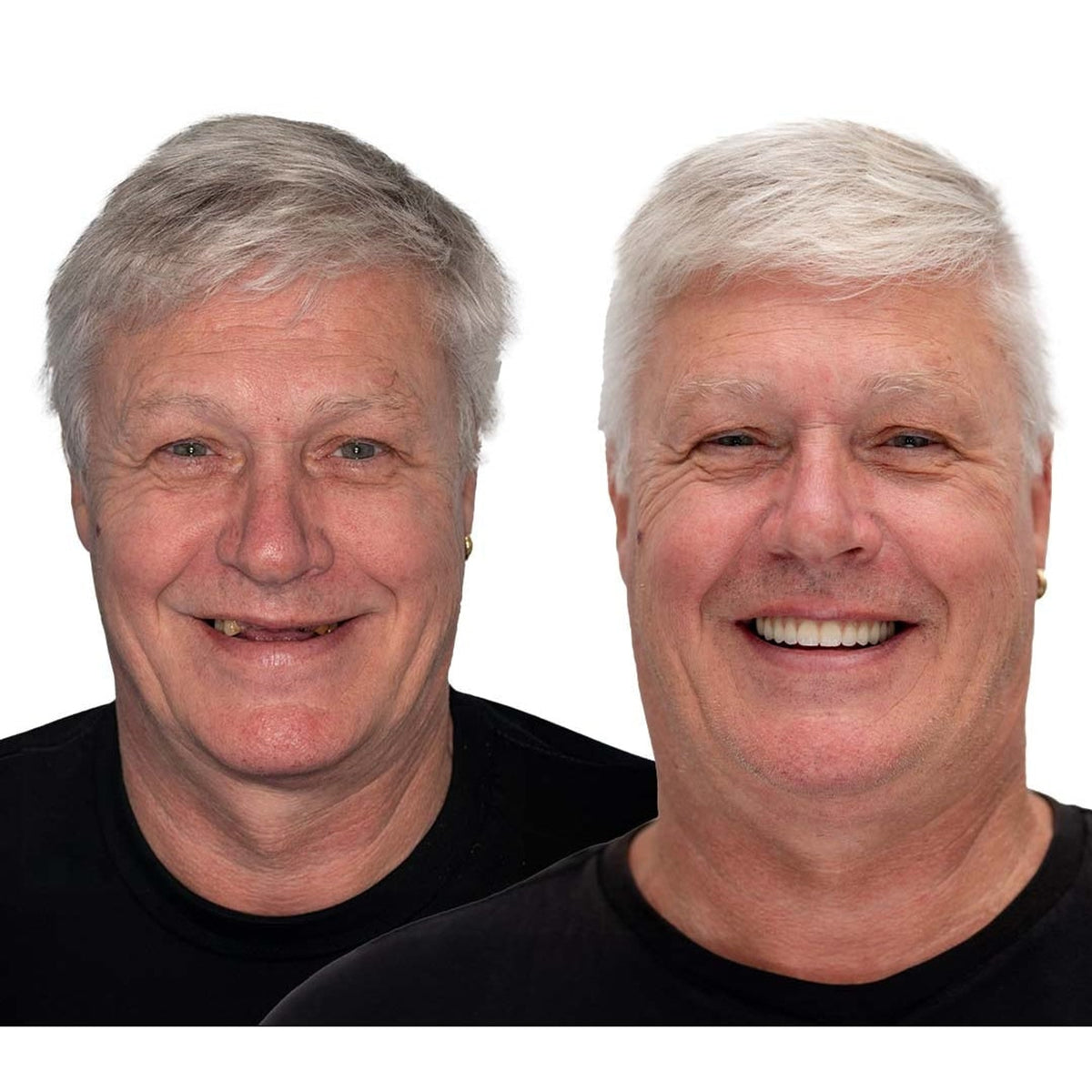 Removable Dentures With Flexible Cushion Grip Full Arch Set For Comfortable Daily Wear - Image 11