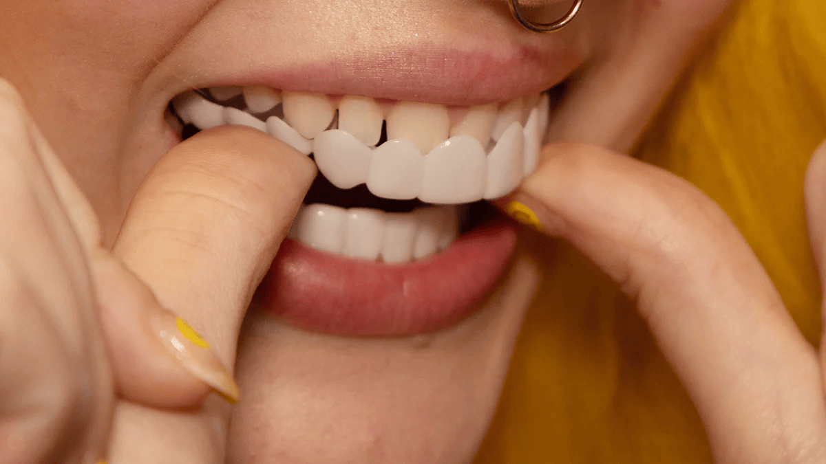 Snap On Veneers For A Natural Smile Correction Instantly - Image 7